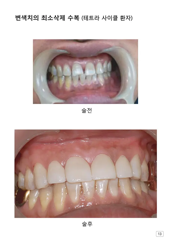라인치과기공 임상사례집 수록 이미지 13