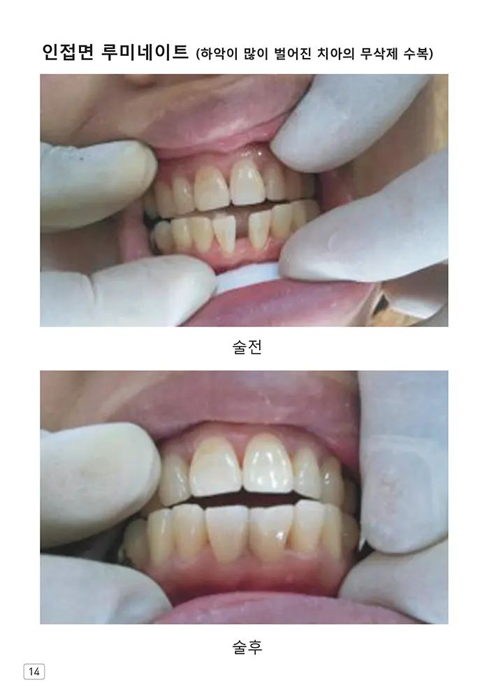 라인치과기공 임상사례집 수록 이미지 14