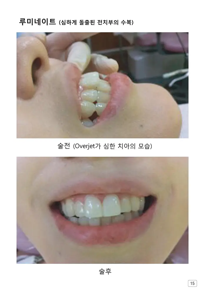 라인치과기공 임상사례집 수록 이미지 15