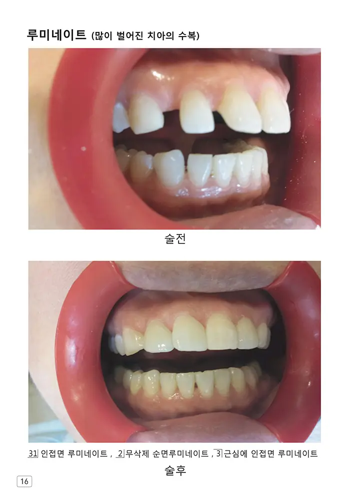 라인치과기공 임상사례집 수록 이미지 16