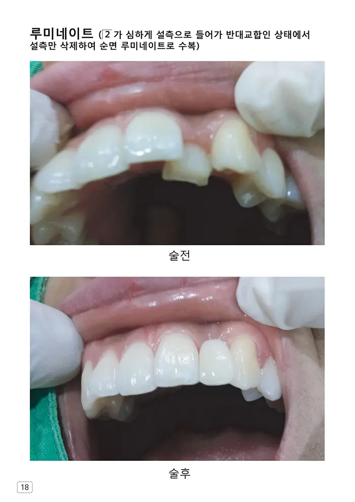 라인치과기공 임상사례집 수록 이미지 18