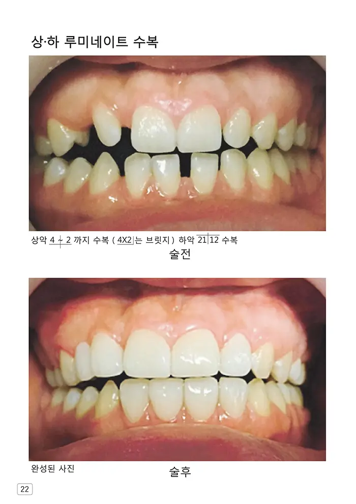 라인치과기공 임상사례집 수록 이미지 22