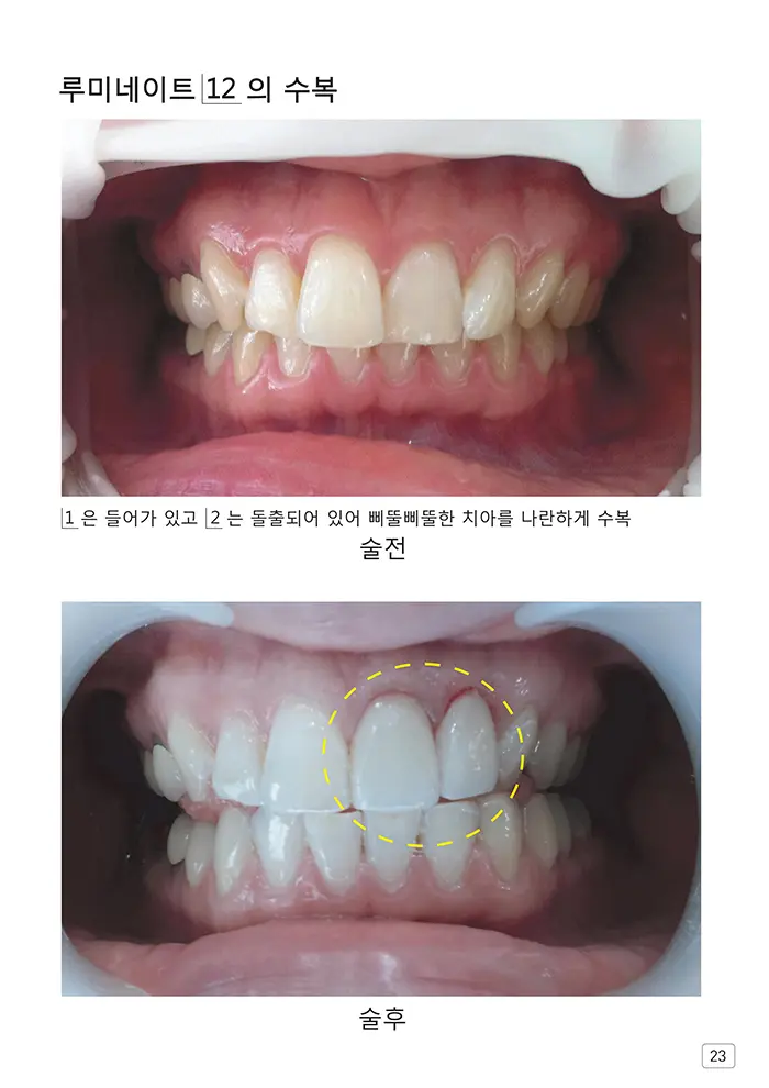라인치과기공 임상사례집 수록 이미지 23