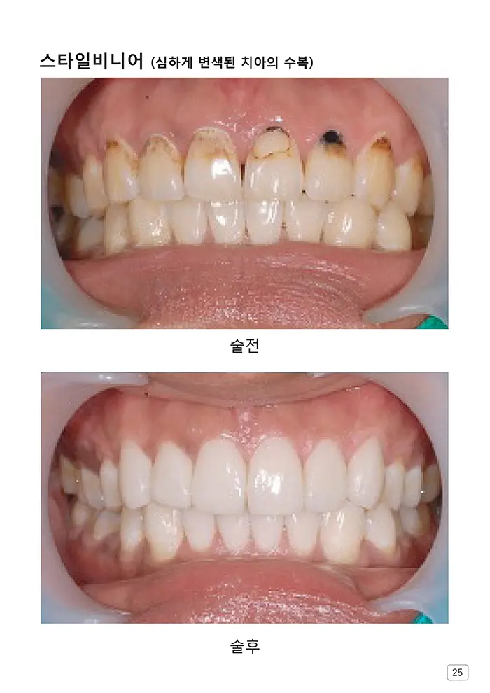 라인치과기공 임상사례집 수록 이미지 25