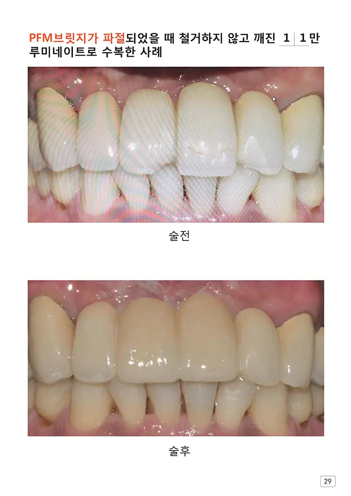 라인치과기공 임상사례집 수록 이미지 29