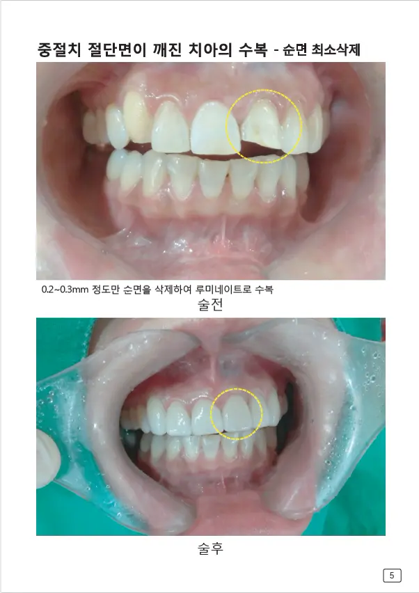 루미네이트 임상사례집 수록 이미지 5