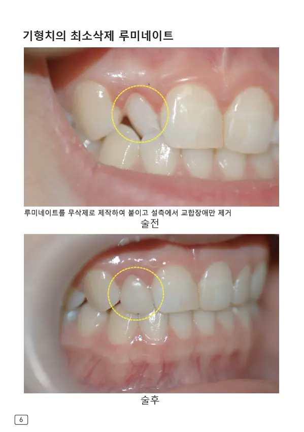 루미네이트 임상사례집 수록 이미지 6