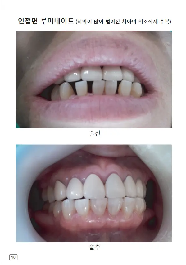 루미네이트 임상사례집 수록 이미지 10