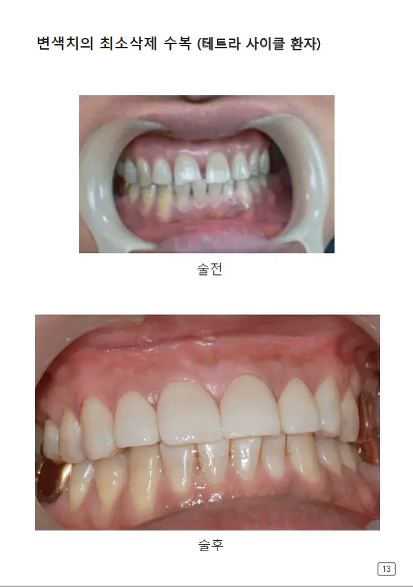 루미네이트 임상사례집 수록 이미지 13
