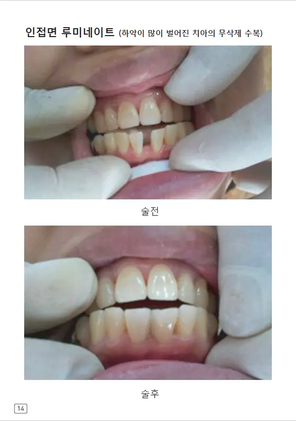 루미네이트 임상사례집 수록 이미지 14