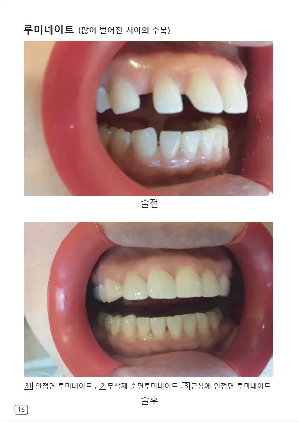 루미네이트 임상사례집 수록 이미지 16