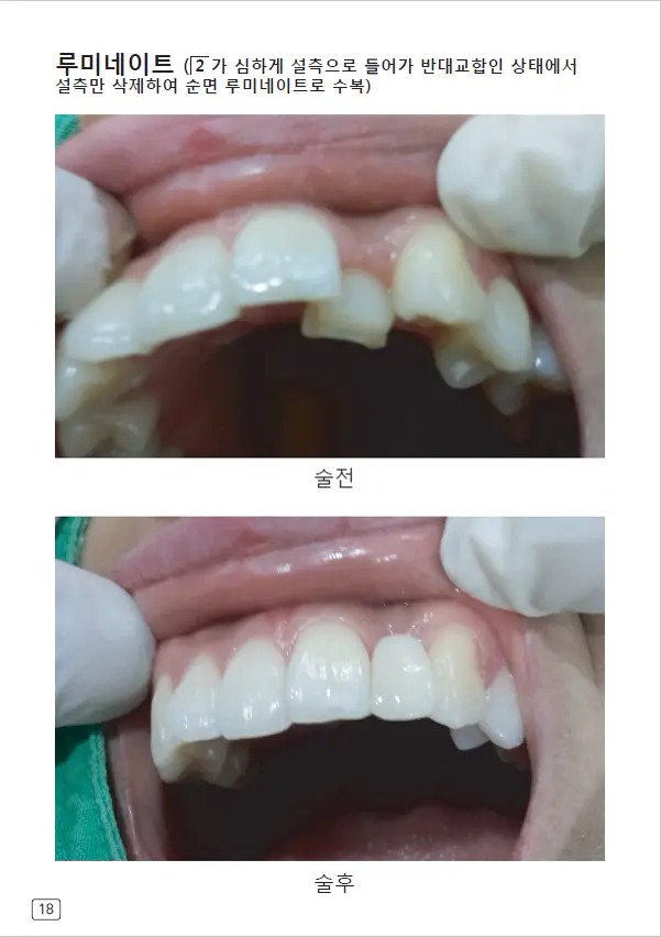 루미네이트 임상사례집 수록 이미지 18