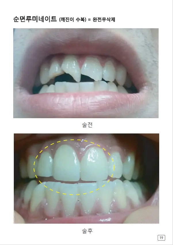 루미네이트 임상사례집 수록 이미지 19