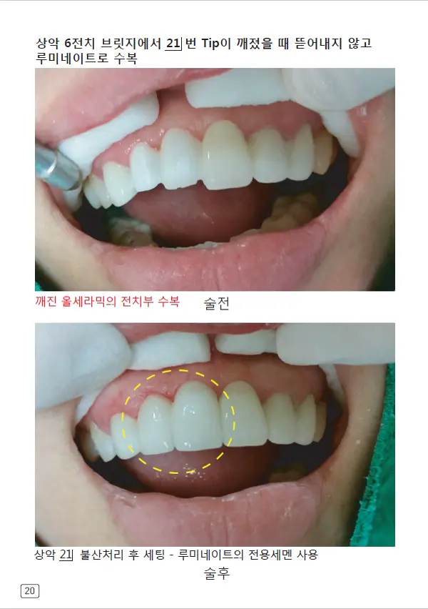 루미네이트 임상사례집 수록 이미지 20