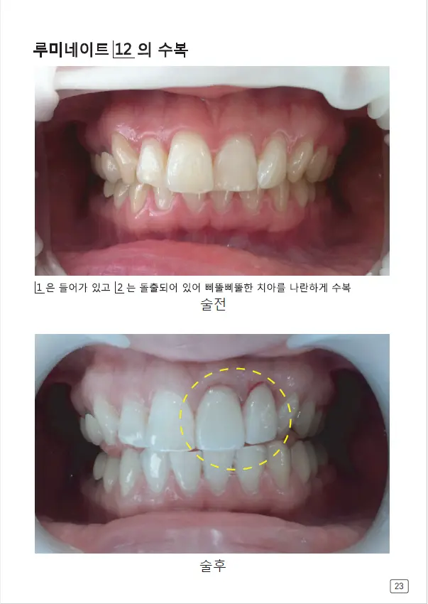 루미네이트 임상사례집 수록 이미지 23