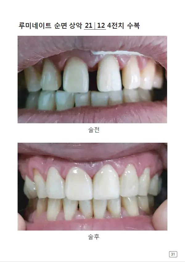 루미네이트 임상사례집 수록 이미지 31
