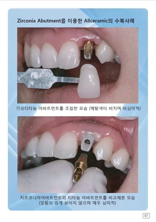 루미네이트 임상사례집 수록 이미지 57