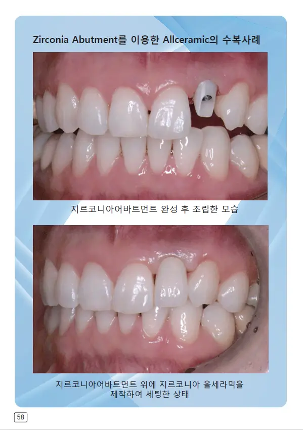 루미네이트 임상사례집 수록 이미지 58