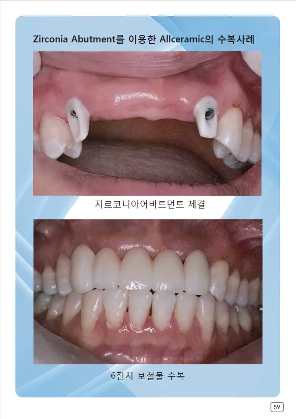 루미네이트 임상사례집 수록 이미지 59
